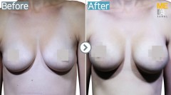 USA / Breast implant (Allergan brand Tear drop type)