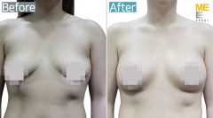 Taiwan / Breast implant (Allergan brand Round type)