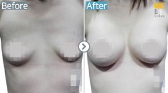 Singapore / Breast implant (Sebbin brand round type)