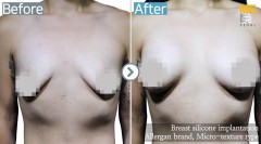 Singapore / Breast implant (Sebbin brand Tear drop type)