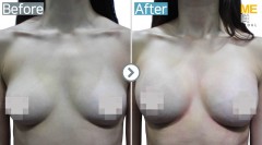 Singapore / Breast implant (Sebbin brand round type)