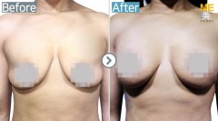 Malaysia / Breast implant (Allergan brand Round type breast implant)