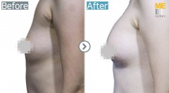 Singapore / Breast implant
(Allergan brand Round type breast implant)