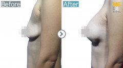 Singapore / Breast implant (Sebbin brand round type)
