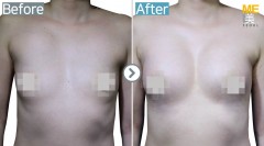 Singapore / Breast implant (Sebbin brand Micro-texture type)