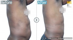 U.S.A / Liposuction (Abdomen liposuction)