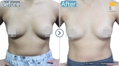 U.S.A / Liposuction (Abdomen liposuction)