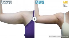 Korea / Liposuction (Both arms)
