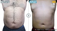 U.S.A / Liposuction (Abdomen liposuction)