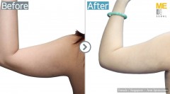 Singapore / Liposuction (Both arms)