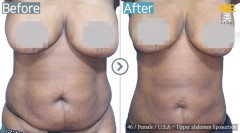 U.S.A / Liposuction (Upper Abdomen liposuction)