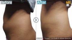 Thailand / Liposuction (Love handle & Abdomen liposuction)