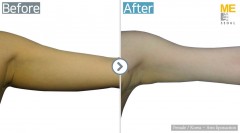 Korea / Liposuction (Both arms)