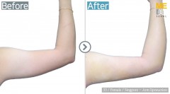 Singapore / Liposuction (Both arms)