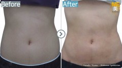 Korea / Liposuction (Abdomen Liposuction)