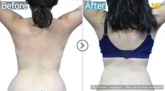 Singapore / Liposuction (Waist and back line liposuction)