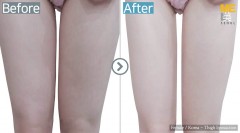 Korea / Liposuction (Thigh Liposuction)