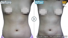 Singapore/ Liposuction (Mini lower Abdomen liposuction)