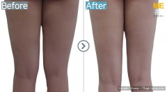 Korea / Liposuction (Thigh Liposuction)