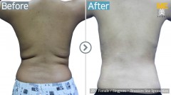 Singapore / Liposuction (Brassiere line liposuction)