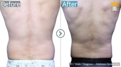 Singapore / Liposuction (Abdomen liposuction)