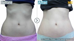 Russia / Liposuction (Love handle liposuction)