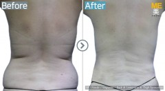 Singapore / Liposuction (Back, Lower arm & Thigh liposuction)