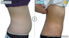 Korea / Liposuction (Abdomen Liposuction)