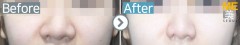 Singapore / Rhinoplasty (Nose alar reduction)