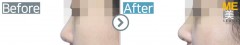 Singapore / Rhinoplasty (Nose tip &Nose bridge)