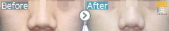 Singapore / Rhinoplasty (Nose bridge, Nose alar reduction & Nose tip)