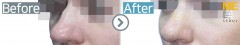 Russia / Rhinoplasty (Nose tip & Nose lifting)