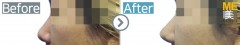 Singapore / Rhinoplasty
(Nose alar reduction)