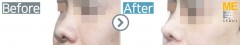 Vietnam / Rhinoplasty (Whole nose)