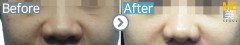 Singapore / Rhinoplasty (Nose alar reduction)