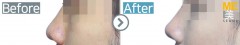 Singapore / Rhinoplasty (Nose bridge& nose tip)