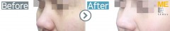 Singapore / Rhinoplasty (Whole nose)