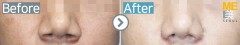Vietnam / Rhinoplasty (Nose alar reduction)