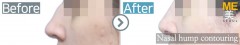 Russia / Rhinoplasty (Hump nose correction& nose lifting)