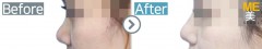 Singapore/Rhinoplasty (Nose bridge&nose tip)