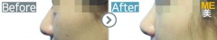 Singapore / Rhinoplasty (Nose bridge& nose tip & nose alar reduction)