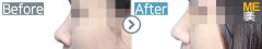 Singapore / Rhinoplasty (Whole nose, nose alar reduction & BTX)