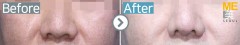 Philippines / Rhinoplasty (Whole nose,nose bridge, nose alar reduction & nose tip)