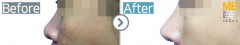 Singapore / Rhinoplasty (Nose bridge,nose alar reduction & nose tip)