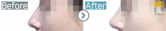 USA / Rhinoplasty (Nose tip)