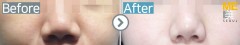 Thailand / Rhinoplasty (Whole nose)