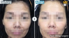 Singapore / Face lifting (Forehead)