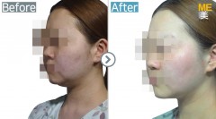Korea / Face lifting