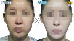 Korea / Face lifting