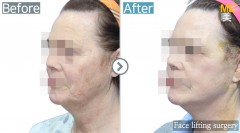 Singapore / Face lifting